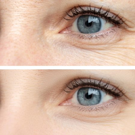 Woman face, eye wrinkles before and after treatment - the result of rejuvenating cosmetological procedures of biorevitalization, botox and pigment spots removal.